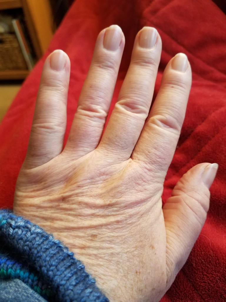 Scleroderma hand