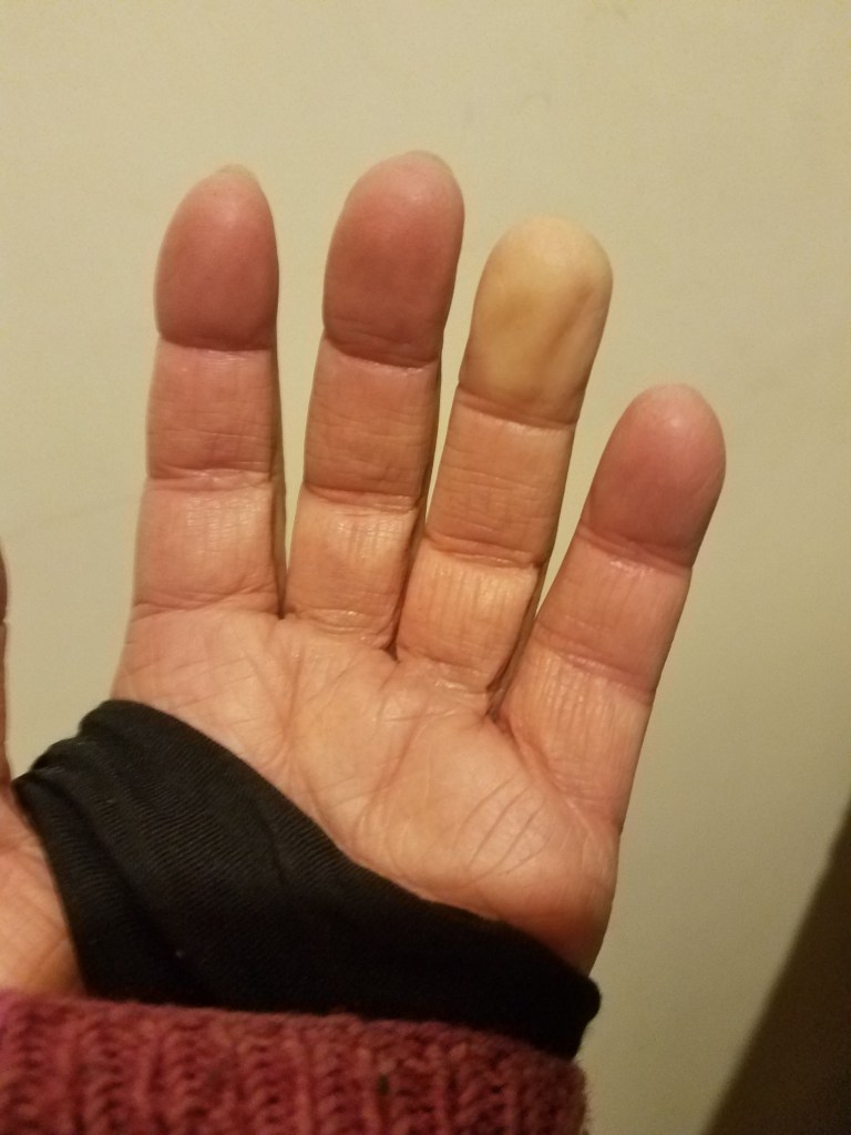 Raynaud's